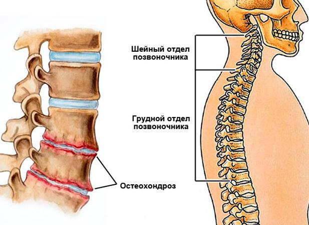 Остеохондроз 3 степени