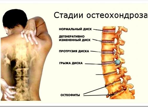 Возможно ли полное излечение от остеохондроза ног