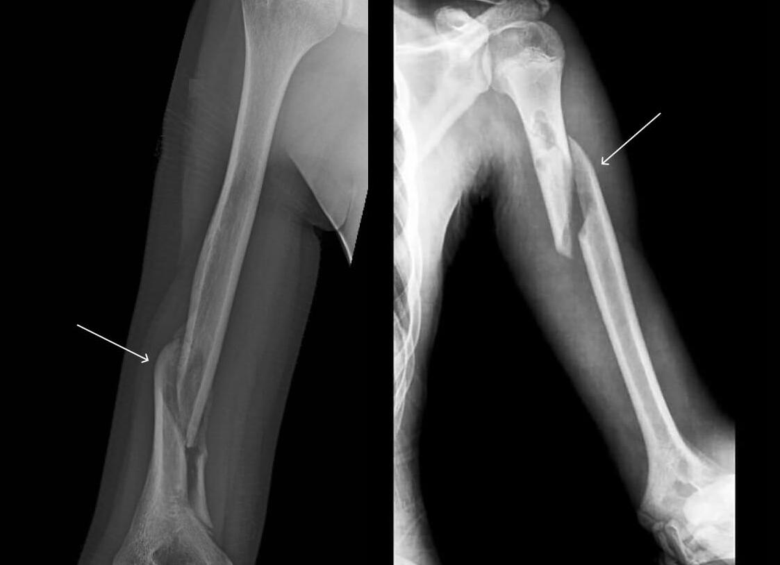 Как правильно действовать при переломе ключицы