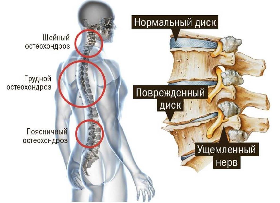 Что такое остеохондропатия и как ее лечить
