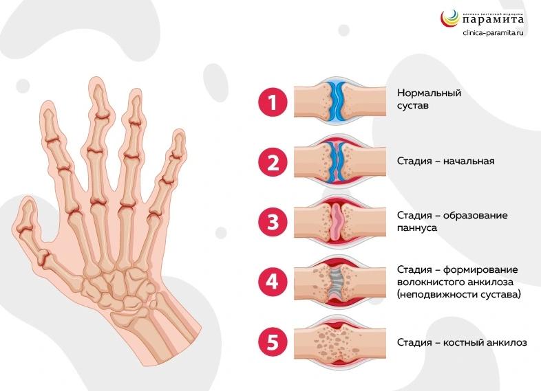 Стадии развития и проявления артрита лучезапястного сустава