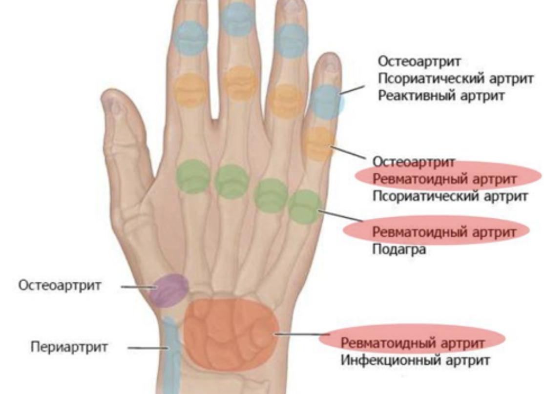 Как проявляется и лечится реактивный полиартрит