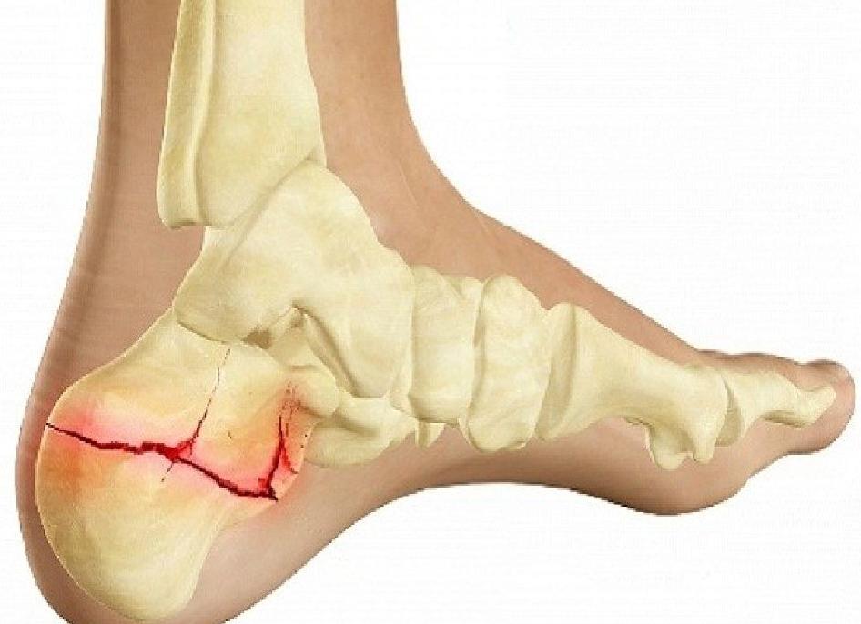 Как определить перелом стопы и начать лечение