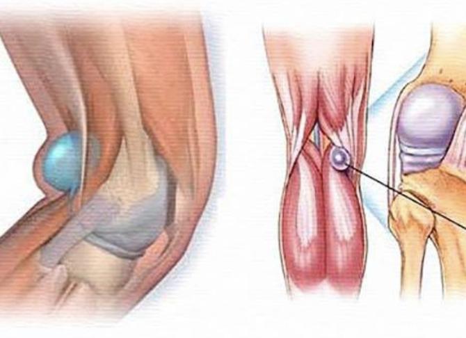 Признаки бурсита гусиной лапки и методы лечения Признаки бурсита гусиной лапки и методы лечения