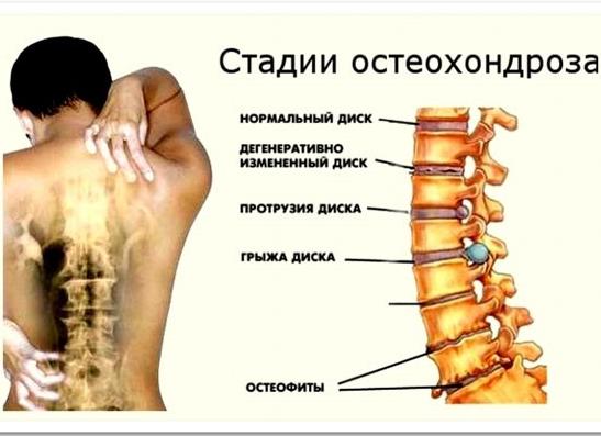 Отличительные признаки разных степеней остеохондроза позвоночника