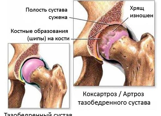 Что такое коксит тазобедренного сустава и в чем его опасность
