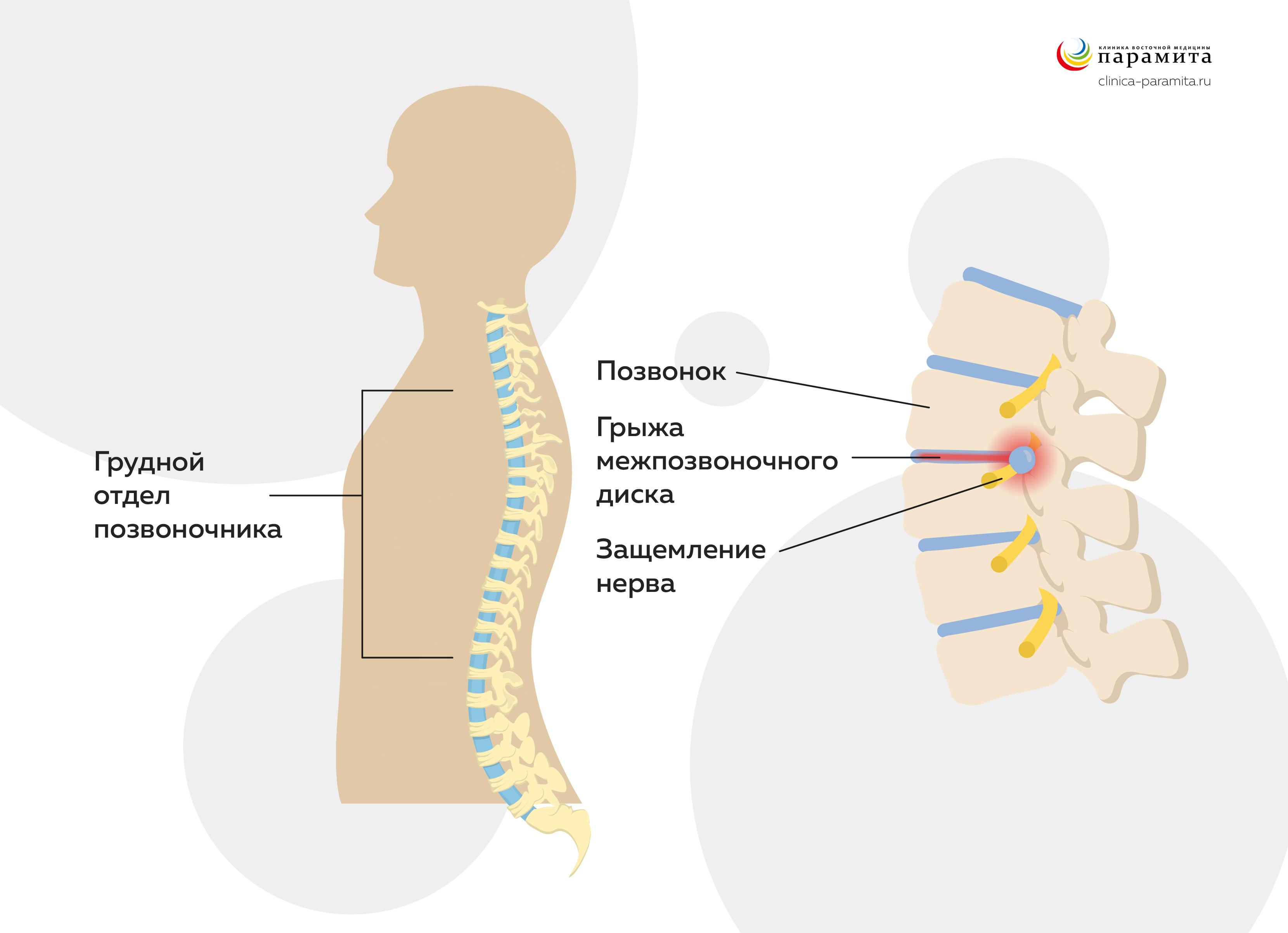 Симптоматика и лечение радикулита грудного отдела