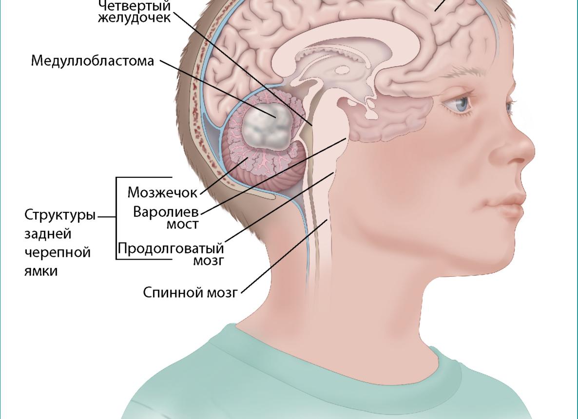 Можно ли вылечить опухоль спинного мозга