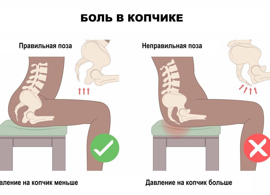 Диагностика перелома копчика и избавление от негативных последствий