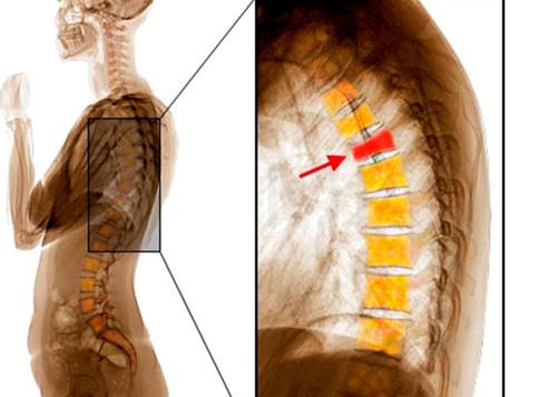 Методы лечения компрессионного перелома позвоночника грудного отдела