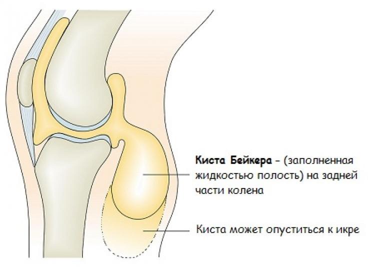 Каких размеров должна быть киста Бейкера коленного сустава размеры, чтобы делать операцию