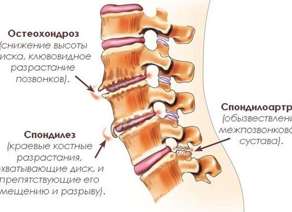 По какой причине происходят дегенеративные изменения менисков коленного сустава