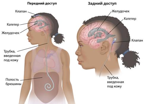 Причины возникновения и диагностика рака спинного мозга