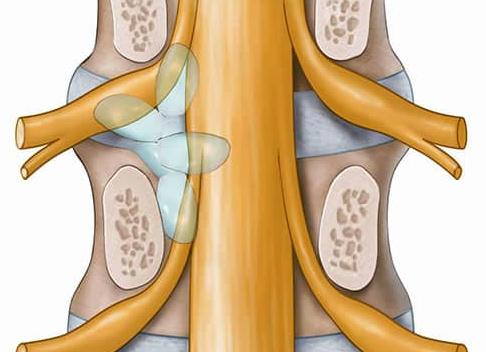 Что такое периневральная киста на уровне s2 позвонка и как ее лечить