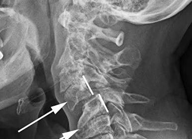 Причины смещения шейных позвонков и как лечить такой недуг