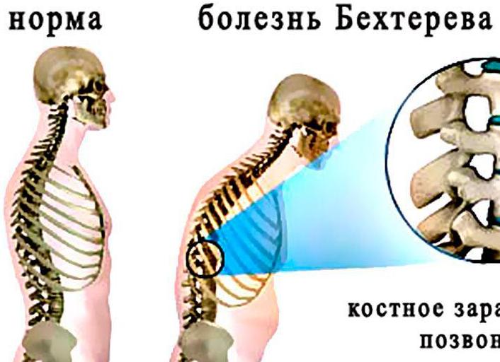 Причины и симптомы развития болезни Бехтерева